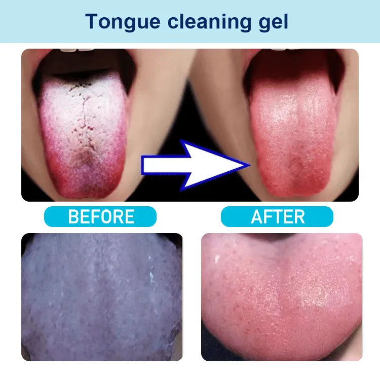 🔥Hot Sale ✨ UP TO 65% OFF🔥 Probiotic Tongue Cleaning Gel Set (Gel + Scraper)